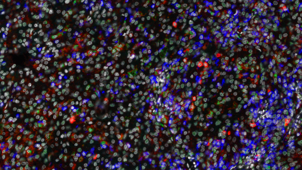 Fluorescent imaging of a tumor section identifies different types of macrophages (green) and T cells (blue) present in the microenvironment of kidney cancer.