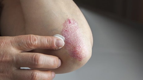 The picture shows a person with common psoriasis, an inflammatory skin disease. 