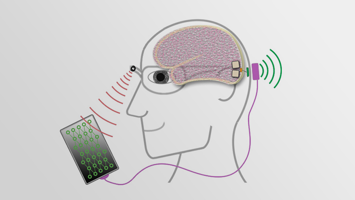 Visualisierung Neuroprothese